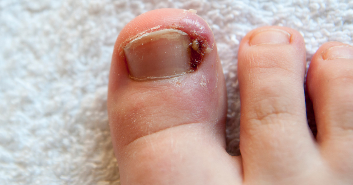 Footcare: ingrown toenail