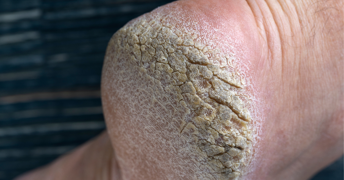 Footcare: Dry and cracked heels