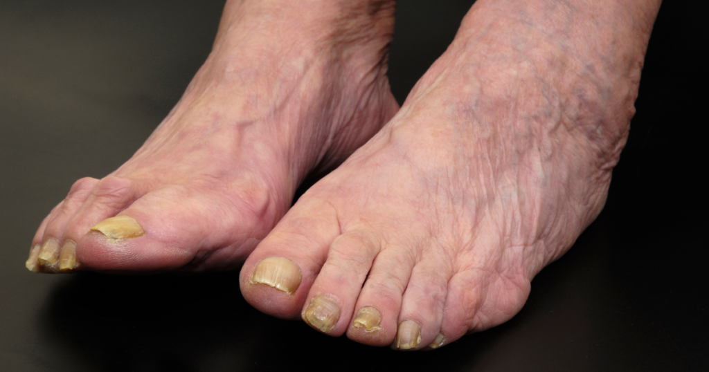 Footcare: Nail fungus